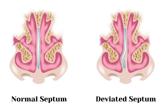 Septoplasty