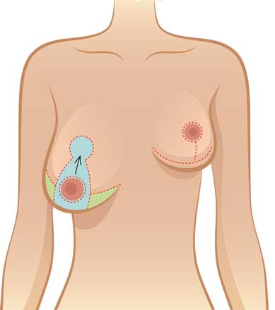 Breast Reduction